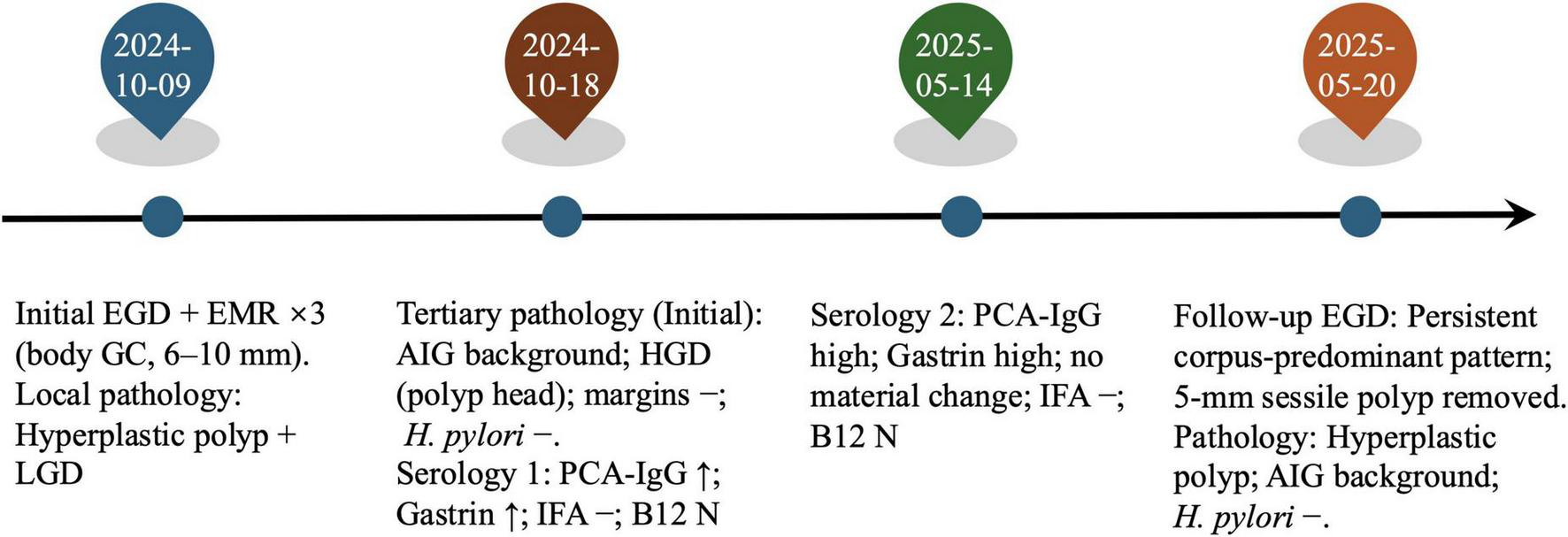 Timeline graphic illustrating a patient’s medical history with key dates and findings. On 2024-10-09, initial endoscopy shows hyperplastic polyp and LGD. On 2024-10-18, initial tertiary pathology reveals AIG background, HGD in polyp head, negative H. pylori, and increased PCA-IgG and gastrin. On 2025-05-14, serology confirms high PCA-IgG and gastrin levels. On 2025-05-20, a follow-up endoscopy removes a 5 mm sessile polyp, confirming persistent corpus-predominant pattern with hyperplastic polyp and AIG background, negative H. pylori.