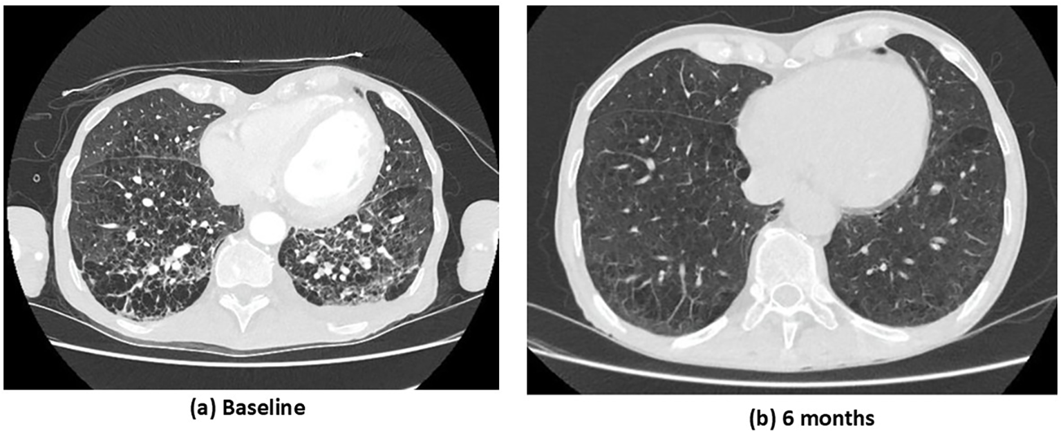Two CT scans of the chest. Image (a) shows a baseline scan with visible mottled appearances in the lungs. Image (b), taken at six months, shows clearer lung fields with reduced mottling.