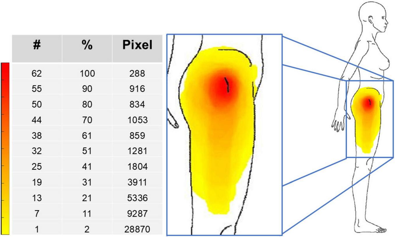 Pain map illustration overlaid on the side view of a woman’s body. A table on the left reports pixel counts, number of patients, percentage of patients.