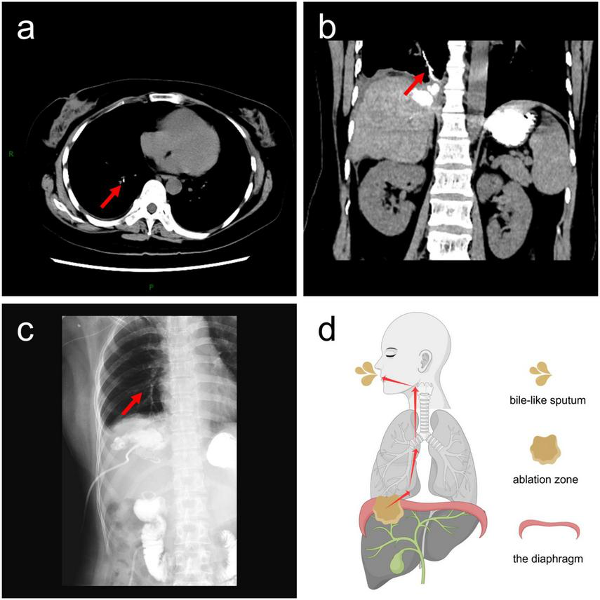 CT scans and X-ray images show abnormalities in the thoracic region marked by arrows, highlighting areas of interest in panels (a), (b), and (c). Panel (d) features a diagram of the human digestive system, illustrating the diaphragm, ablation zone, and bile-like sputum with labeled indicators.