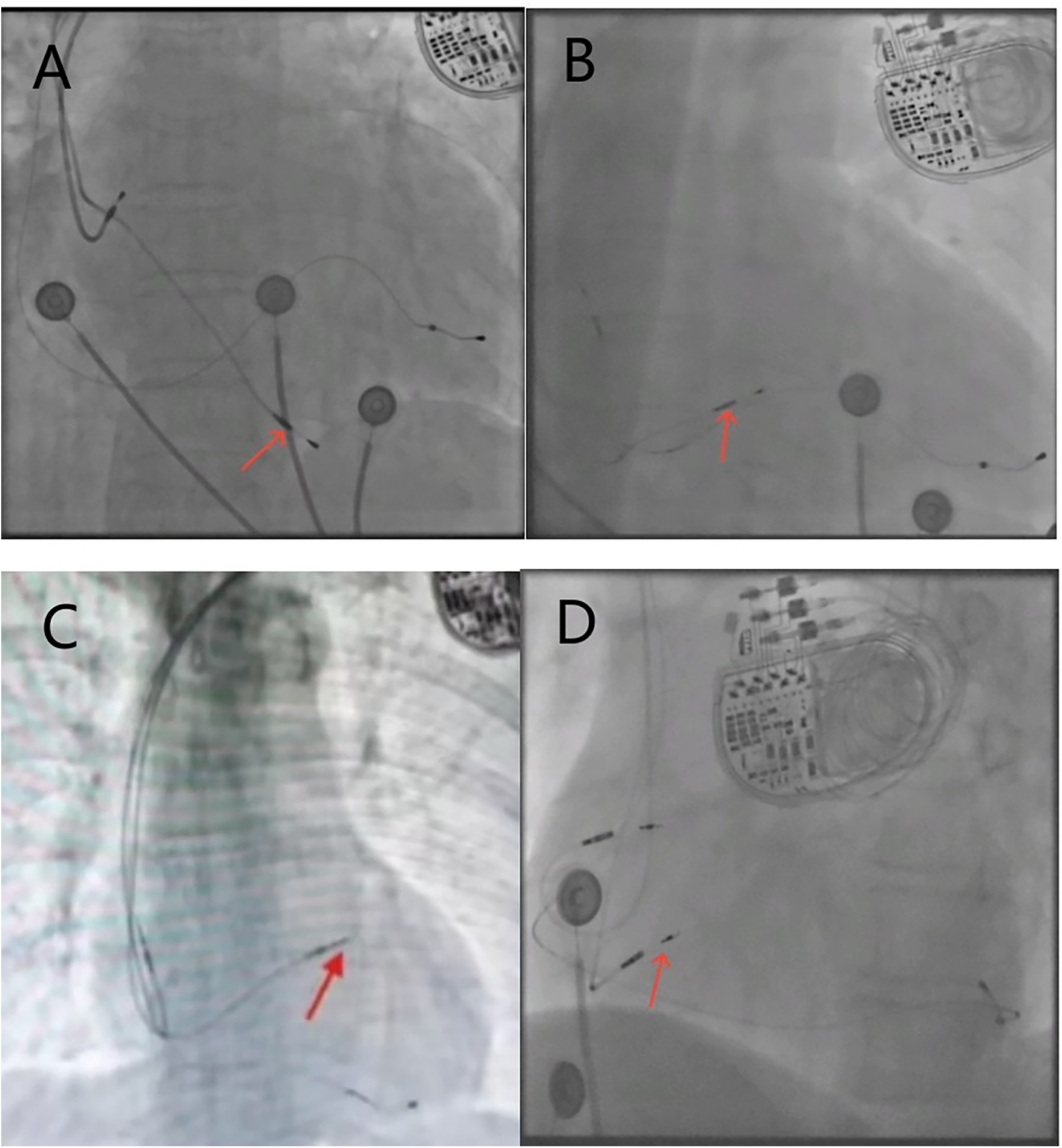 X-ray images showing cardiac devices implanted in the chest. The red arrows indicate specific leads or wires connected to the devices, placed at different positions in the images.