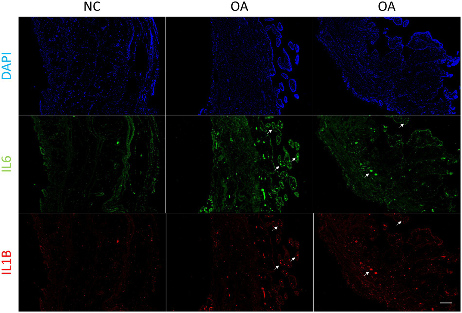Fluorescent microscopy images in a grid format with three columns labeled NC and OA, and three rows labeled DAPI, IL6, and IL1B. The top row shows blue DAPI staining, indicating cell nuclei. The middle row presents green IL6 staining, while the bottom row shows red IL1B staining. The NC column appears less intense compared to the OA columns, which show increased fluorescence, particularly in the IL6 and IL1B rows, indicating different levels of protein expression.