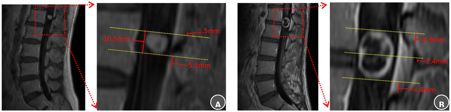 Anatomical landmarks of the lamina and ligamentum flavum boundaries selection and radiological evaluation. (A) L1 intraspinal schwannoma: The superior tumor pole was closest to the superior margin of the L1 lamina, recorded as Ts = L1-sup – 1.5 mm, It was also 1.5 mm inferior to the T12 ligamentum flavum (Ts = T12 LF-inf − 1.5 mm). The inferior pole lay 5.5 mm superior to the L1 ligamentum flavum inferior border (Ti = L1 LF-inf + 5.5 mm). The surgical approach was planned using the superior L1 lamina as the cranial guidance. Laminectomy commenced superiority to expose the upper pole and proceeded caudally within two-thirds of the channel diameter to reveal the inferior pole, ensuring preservation of the L1 ligamentum flavum. (B) L1–2 intraspinal schwannoma: The tumor midportion was closest to the L1 lamina inferior margin (Tm = L1-inf + 2.4 mm). The superior pole was 3.9 mm superior to the L1 ligamentum flavum (Ts = L1 LF-sup + 3.9 mm), while the inferior pole was 4.4 mm superior to the L2 ligamentum flavum inferior border (Ti = L2 LF-inf + 4.4 mm). Surgical planning designated the inferior L1 lamina as the midpoint reference. Bone removal began at this point, continued until exposing the L1 ligamentum flavum superior boundary with an additional 5 mm resection, and extended caudally only to the L1 ligamentum flavum inferior border.