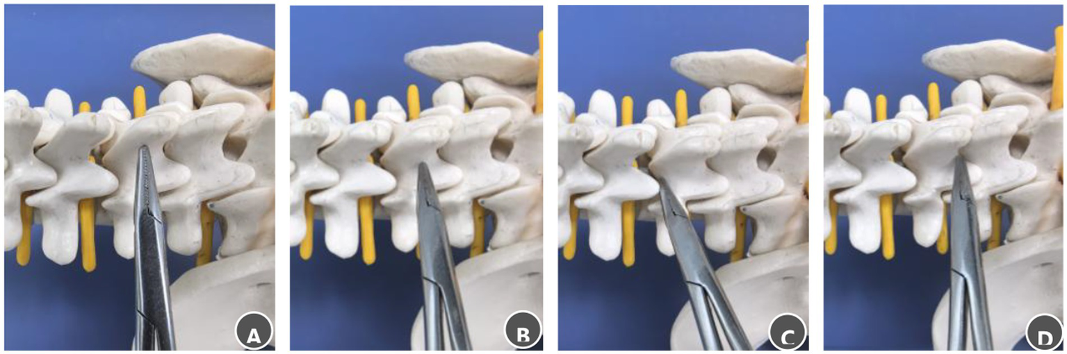 Steps for palpating bony landmarks in the posterior lumbar spinal canal. (A) Advance the clamp tip medially along the lumbar spinous process to locate the midline. (B) Slide the clamp tip caudally along the spinous process to the spinous process–lamina junction. (C) Move the clamp tip cephalad along the junction between the spinous process root and the lamina, a distinct loss of resistance indicates the M-point. (D) Move the clamp tip caudally along the same junction; a distinct loss of resistance indicates the S-point.