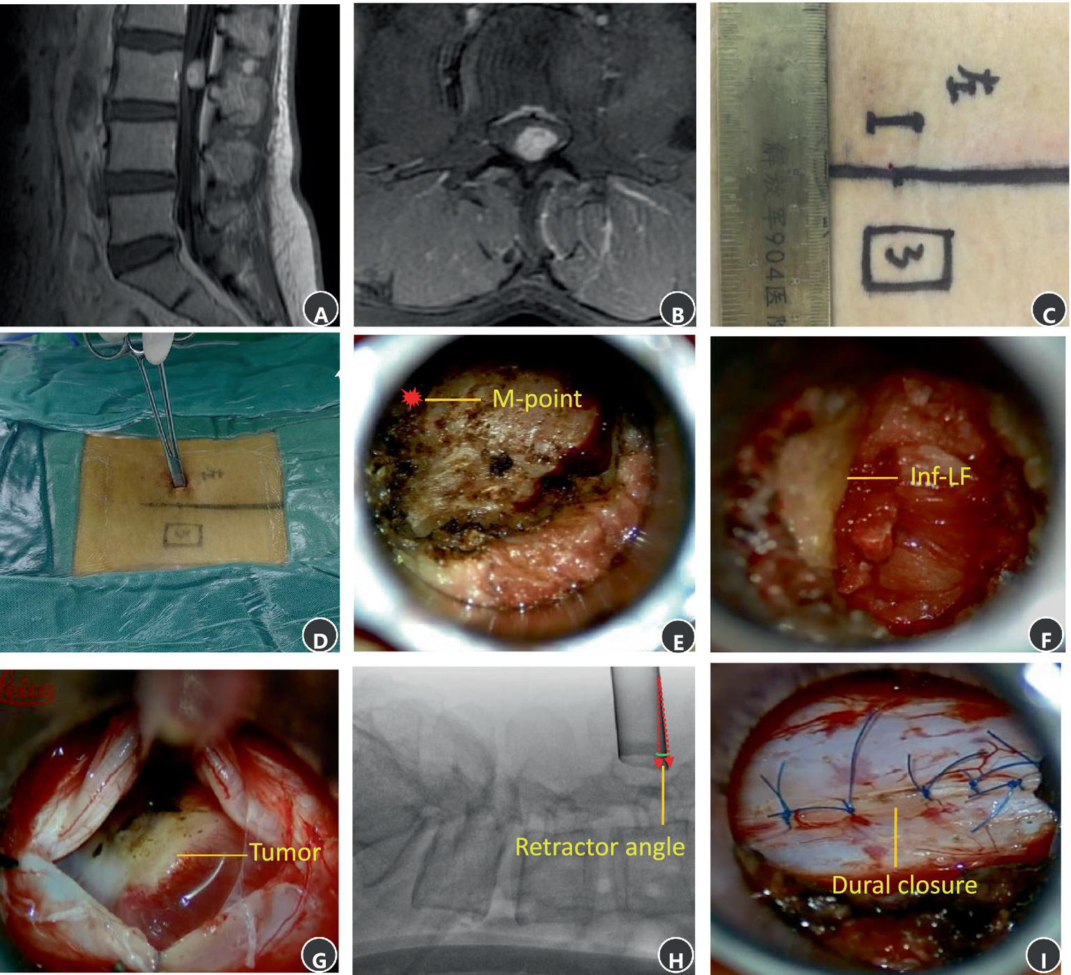 MRI and intraoperative surgical photos of schwannoma at the L3 level. (A) A sagittal T1 contrast image. (B) An axial T1 contrast image. (C) Surgical incision. (D) Palpating the M-point. (E) The M-point lies at the cephalad aspect of the operative field. (F) The inferior boundary of previous segment ligamentum flavum at the cephalad aspect of the operative field. (G) The main tumor mass is exposed and visualized at the center of the surgical corridor. (H) An intraoperative X-ray image showing retractor angle after exposed the main tumor mass. (I) Interrupted suture of the dura.