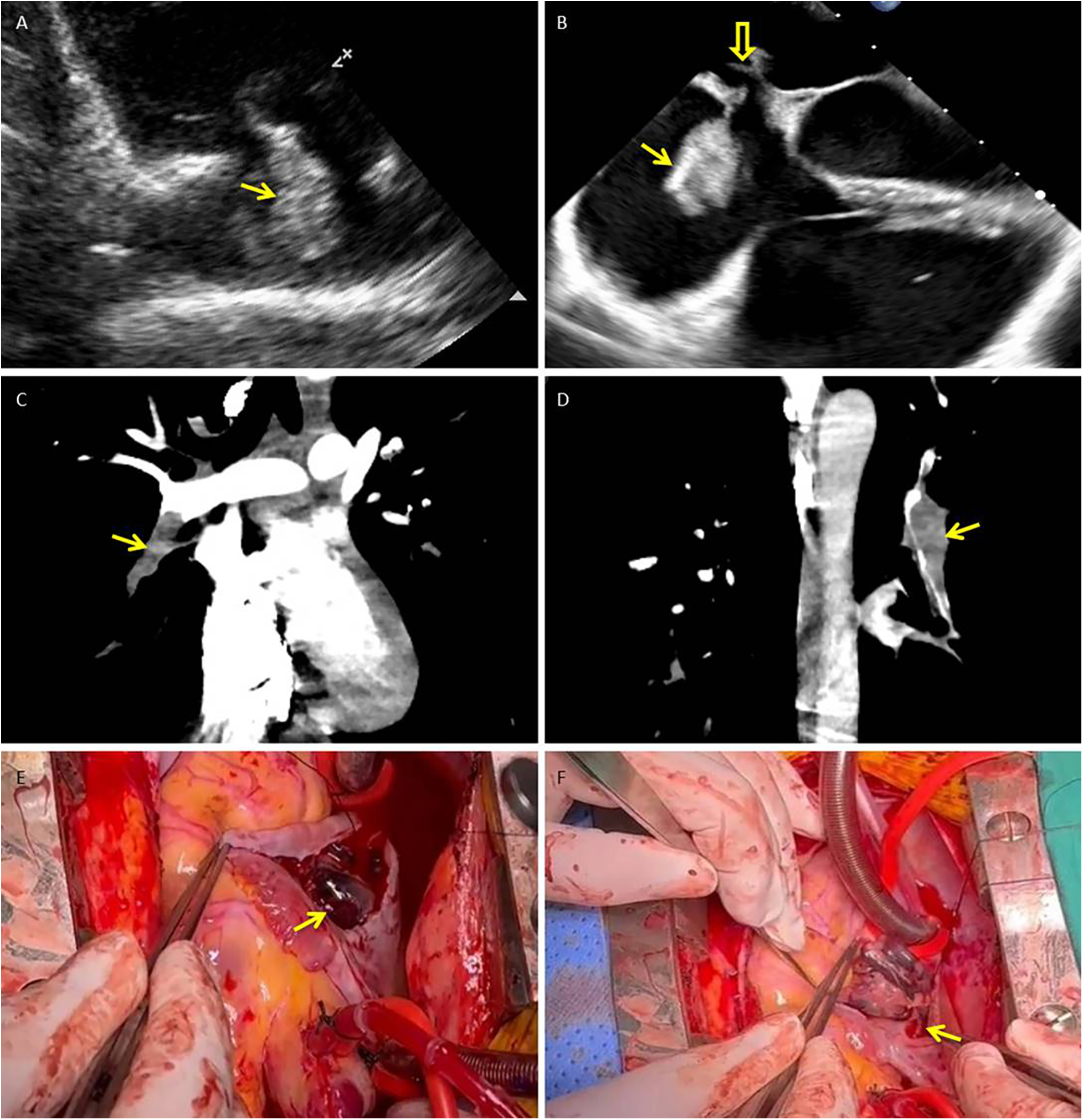 Medical images showing cardiac evaluations and surgical procedures. Panel A and B display ultrasound images of the heart with arrows pointing to areas of interest. Panel C and D show CT scans with indicated anomalies in the heart region. Panel E and F depict surgical views of an open-heart procedure, highlighting areas being operated on with arrows pointing to specific regions of focus.