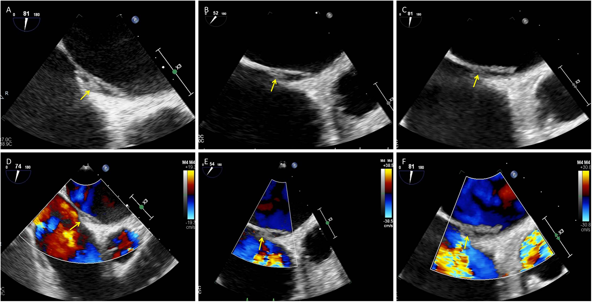 Six-panel ultrasound images display cardiac views, each marked by a yellow arrow indicating areas of interest. Panels A to C show grayscale views, while D to F incorporate color Doppler imaging highlighting blood flow dynamics in blue and red.