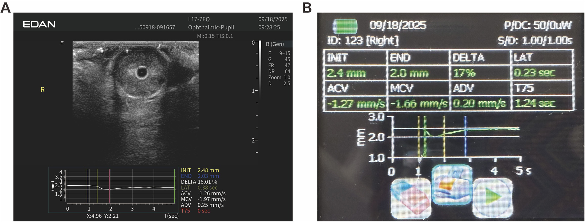Panel A displays an ocular ultrasound image with measurements and graph data related to an ophthalmic exam. Panel B shows a screen with ophthalmic measurement results, including values for INIT, END, DELTA, among others, with a graph depicting changes over five seconds.