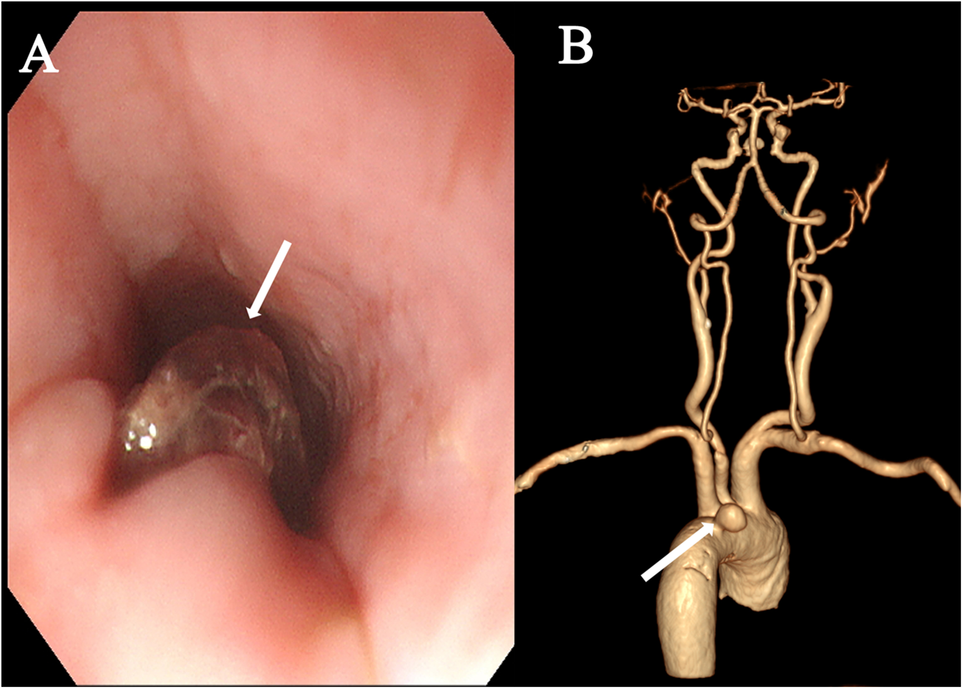 Panel A shows an endoscopic view of the esophagus with a visible lesion indicated by an arrow. Panel B displays a 3D reconstruction of blood vessels with an aneurysm highlighted by an arrow.