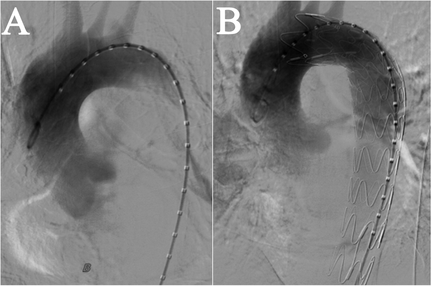 Angiographic images showing: A) pre-stent placement with visible aortic arch and catheter; B) post-stent placement in the aortic arch with an implanted stent visible, depicting improved structural support.