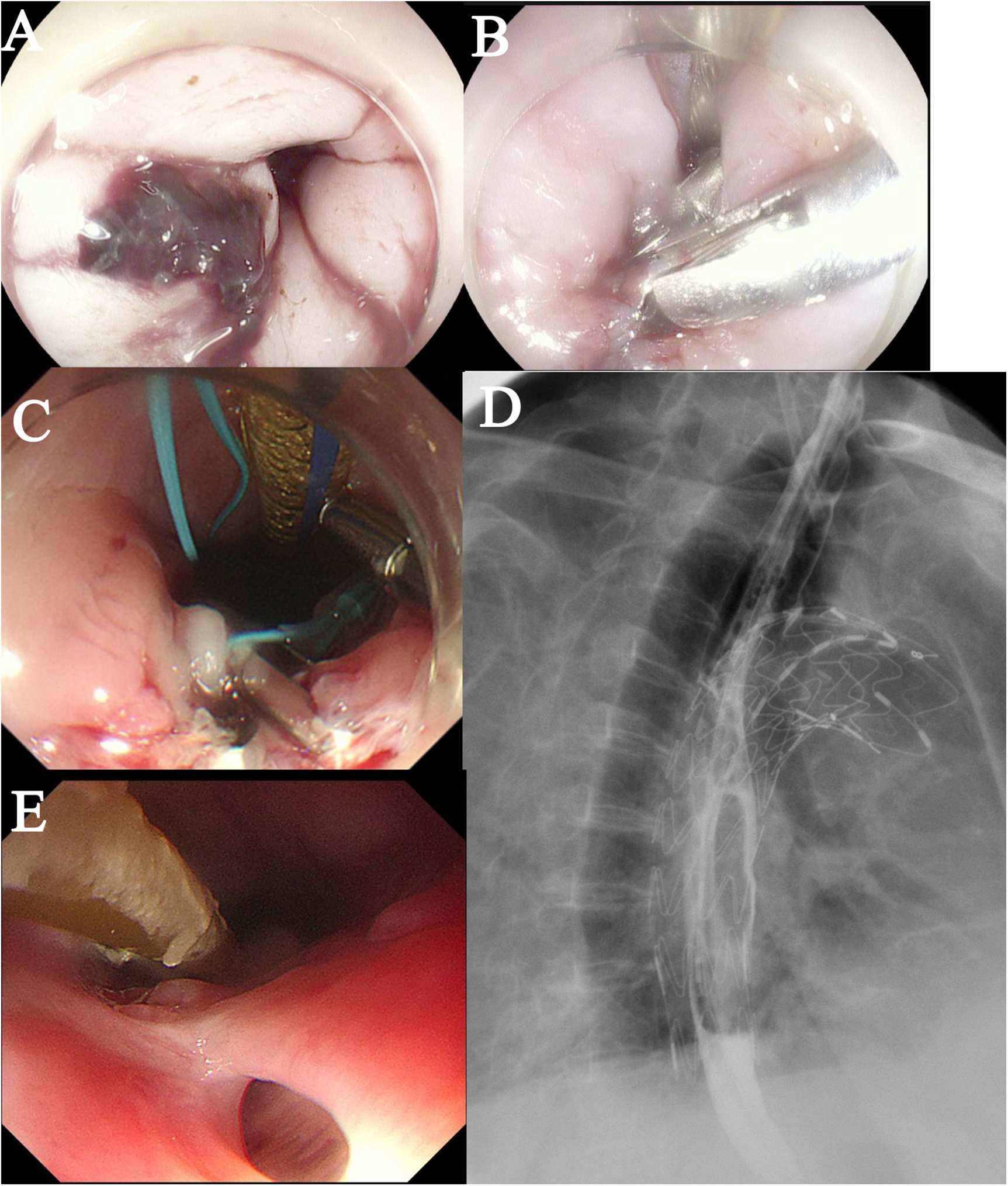 A set of medical images showing different views and procedures related to the esophagus. Image A depicts an endoscopic view of a bleeding region. Image B shows an endoscopic procedure with surgical instruments. Image C includes medical devices inserted into the esophagus. Image D is an X-ray depicting a stent in place within the esophagus. Image E shows the esophagus with visible surgical intervention.