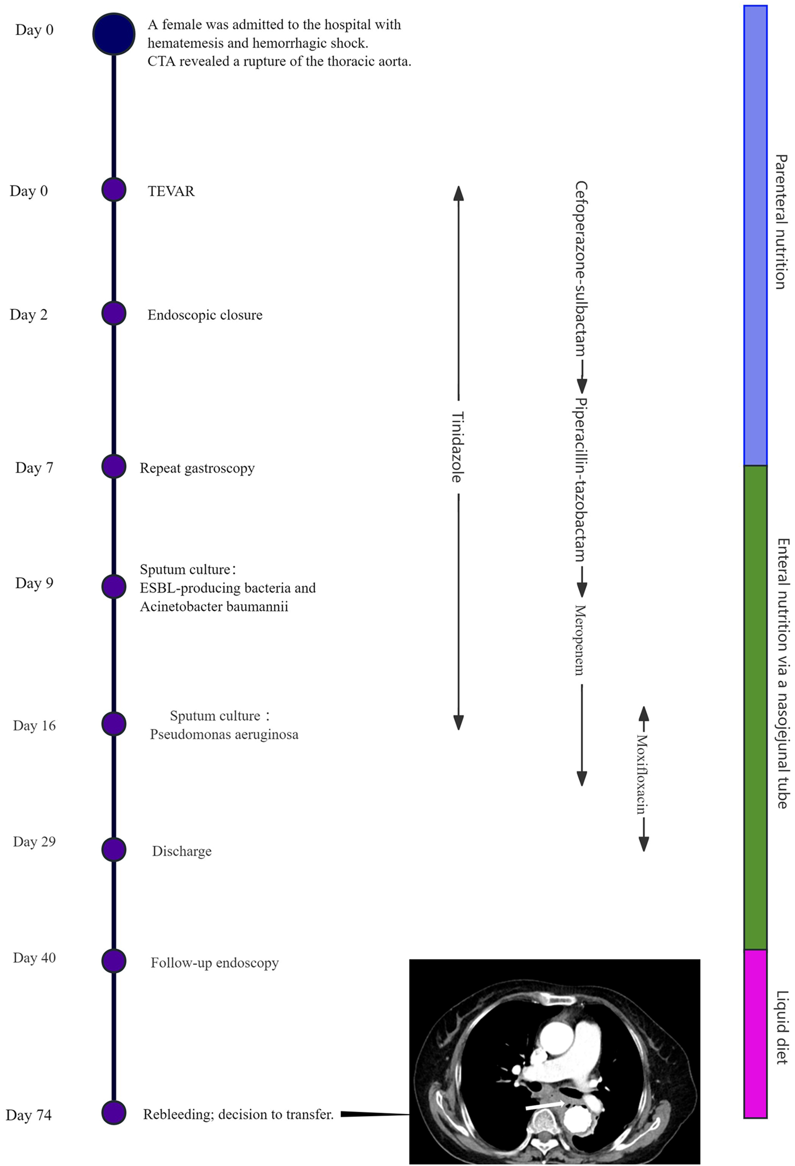 Timeline detailing a patient's medical journey following thoracic aorta rupture. Events include hospital admission, procedures such as TEVAR and endoscopic closure, bacterial cultures, and discharge. Nutritional support is detailed on a vertical bar, indicating parenteral, enteral nutrition, and liquid diet. Medications like tinidazole and meropenem are noted. The timeline spans from initial admission (Day 0) to rebleeding (Day 74). A CT scan image of the thorax is included at Day 74.