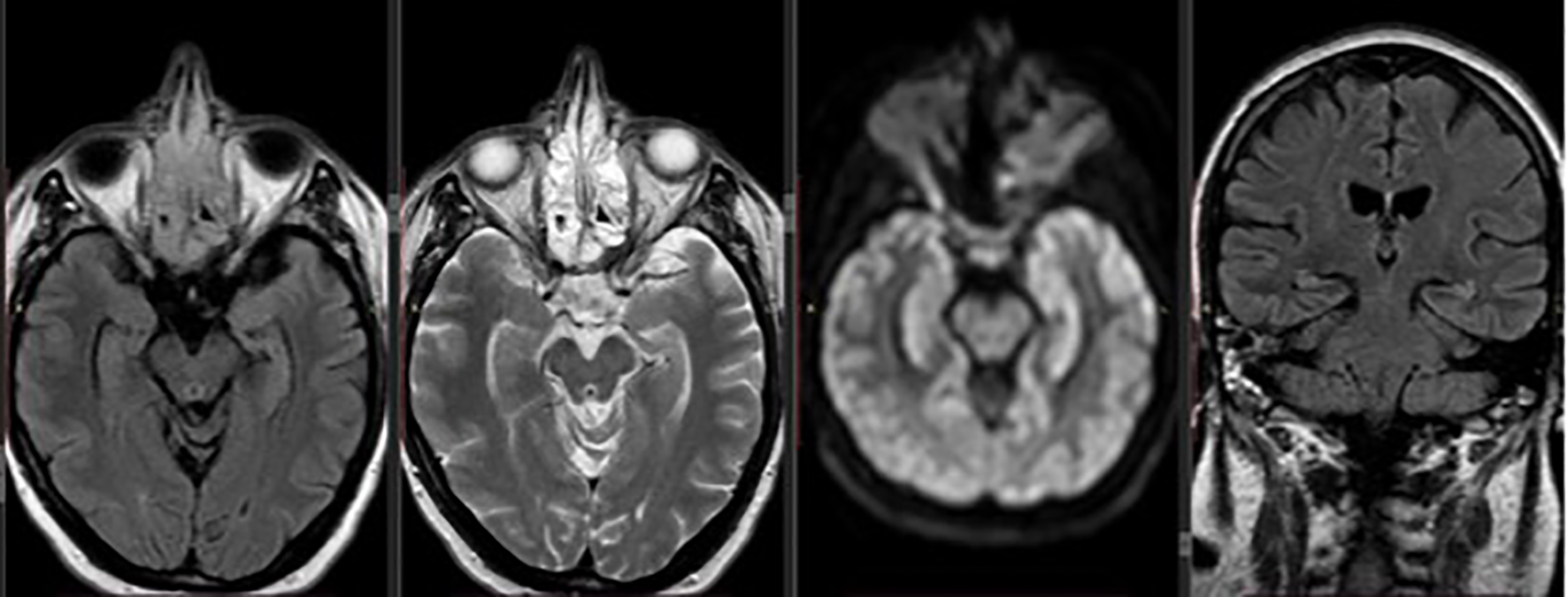 Four MRI brain scans show different sections of the brain. The first three images are axial views, capturing cross-sections at varying depths. The fourth image is a coronal view, depicting a frontal section. Each scan reveals structural details of brain tissues and ventricles.