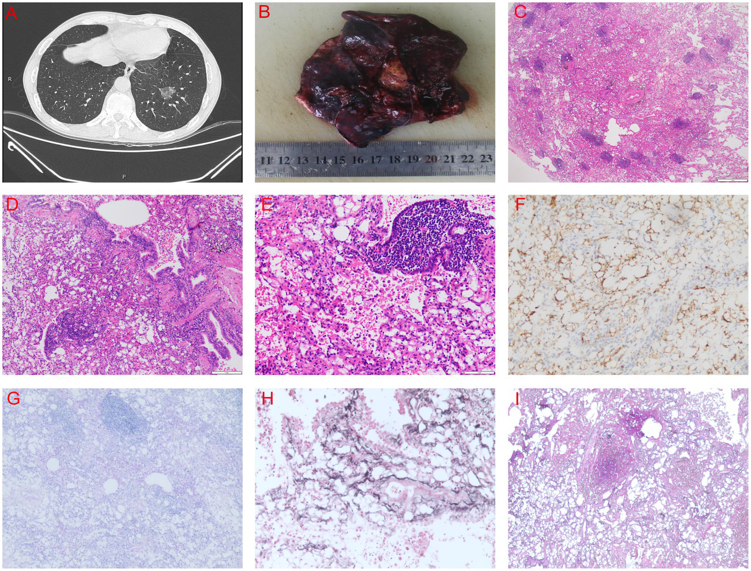 A set of nine medical images. A: Chest CT scan showing lung tissue. B: Surgically removed dark tissue with scale measurement. C to E: Microscopic images of lung tissue with varying cellular structures. F: Tissue section with brown staining, likely indicating immunohistochemistry. G: Pale-stained tissue section. H: Tissue with blood vessels and fibrous structures. I: Microscopic view with visible cellular patterns and possible inflammation.