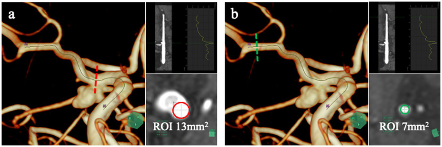 An image showing two comparative views of vascular structures labeled “a” and “b”. The left side, “a,” includes a region of interest (ROI) marked on the internal carotid artery with an area of 13 square millimeters. The right side, “b,” includes an ROI marked on the middle cerebral artery with an area of 7 square millimeters. Both display 3D and sectional views with corresponding measurement indicators.