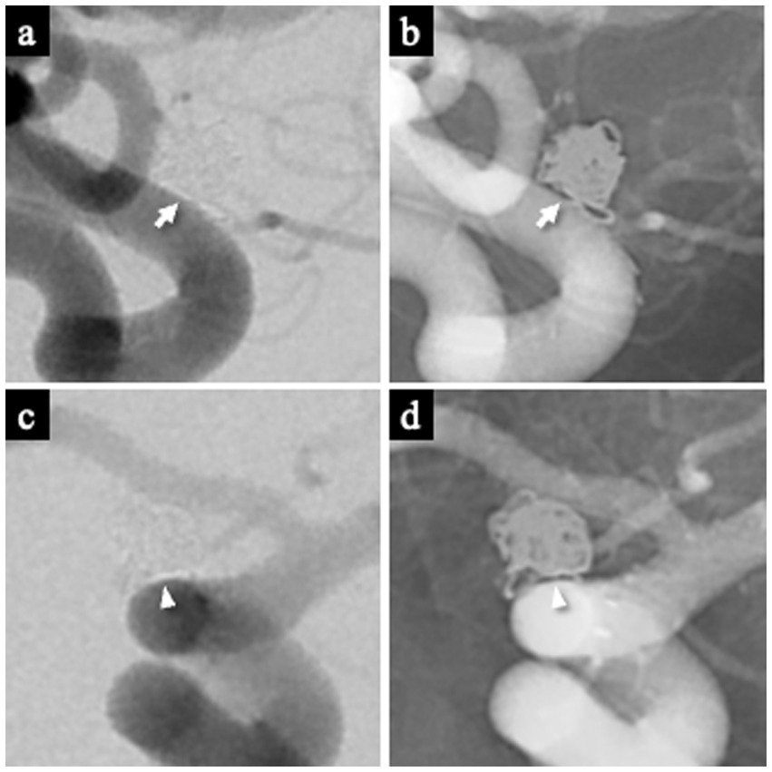 The two panels labeled a and c are DSA images, while the two panels labeled b and d are nonsubtracted images. The arrows in panels a and b and the arrowhead in panels c and d indicate the white-collar sign.