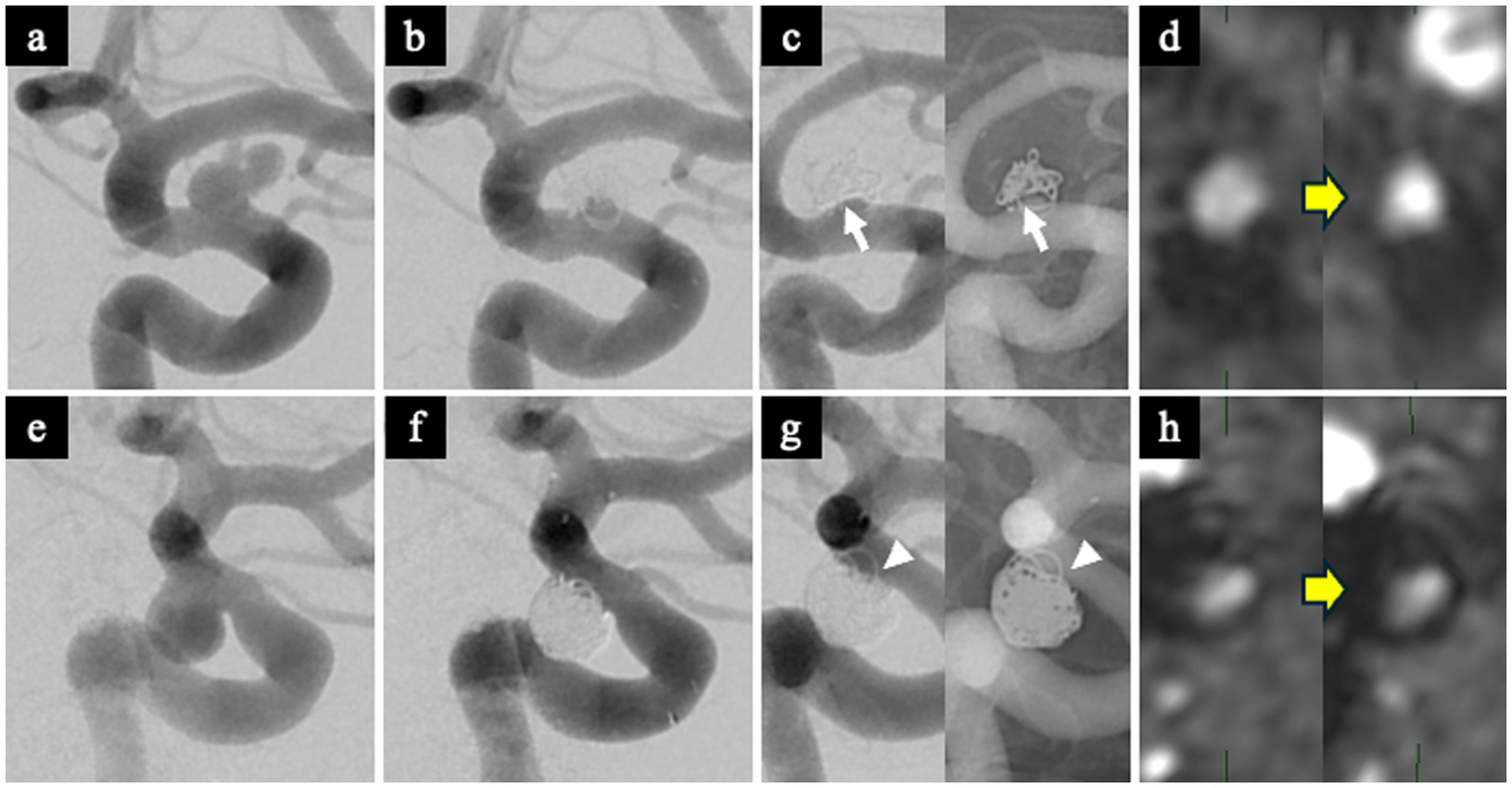 A series of angiographic and MRI images (labeled a-h) illustrating a cerebral aneurysm and its treatment. Images a, e show preoperative angiograms, while images b, f show postoperative angiograms. Image c is a one-year follow-up angiogram highlighting the appearance of WCS with arrows. Image g is a one-year follow-up angiogram highlighting the absence of WCS with arrowhead . Images d, h are MRI, with yellow arrows highlighting changes in signal intensity on TOF.