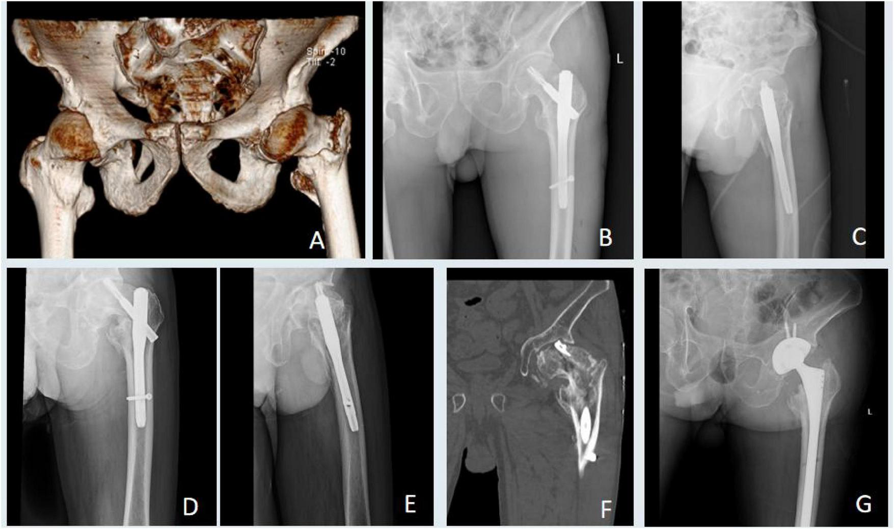CT scan and X-ray images display a pelvis and hip area. Image A shows a detailed 3D CT scan of the pelvic bones. Images B to E reveal various views of the hip with internal fixation hardware. Image F is a CT scan with a cross-sectional view of the hip joint. Image G shows a post-hip replacement X-ray with a prosthetic implant. Each image focuses on different stages and aspects of hip treatment.