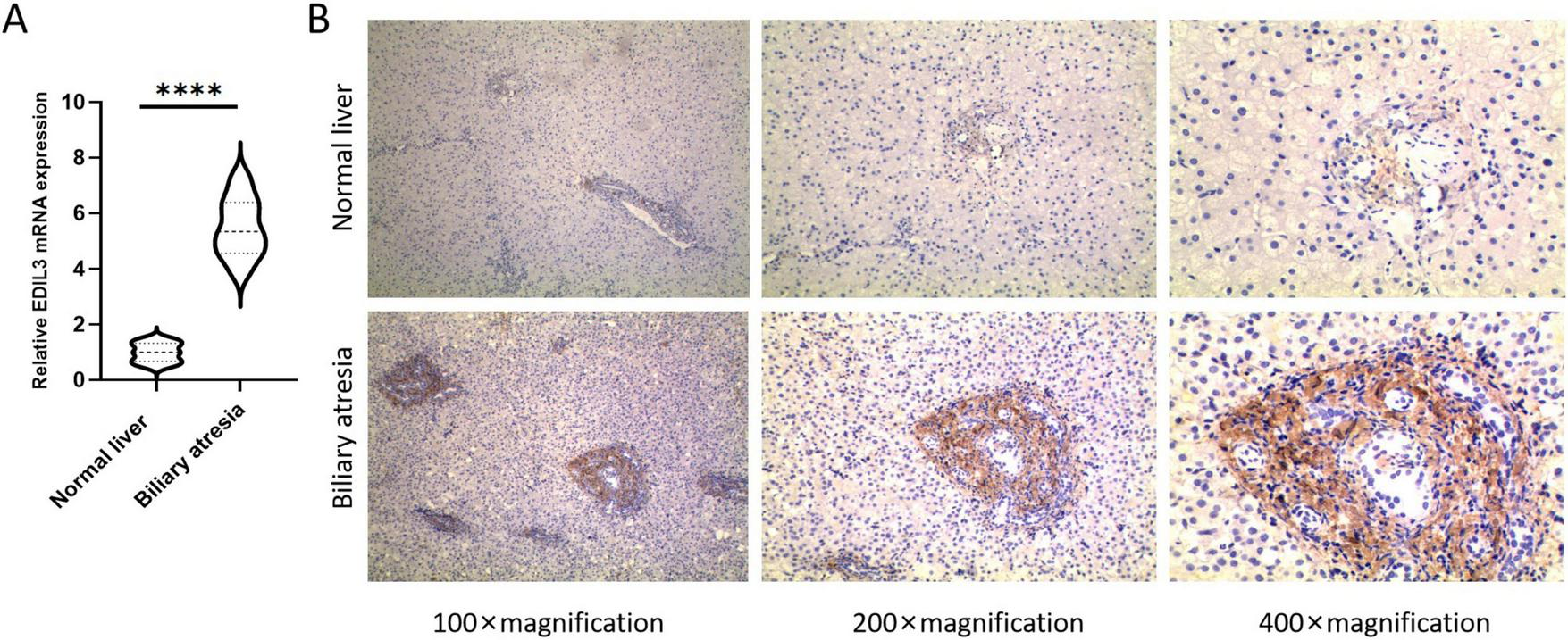 Violin plot and histology images compare normal liver and biliary atresia. Panel A displays elevated EDL3 mRNA expression in biliary atresia. Panel B shows microscopic views of liver tissues at 100x, 200x, and 400x magnifications, highlighting structural differences between conditions.