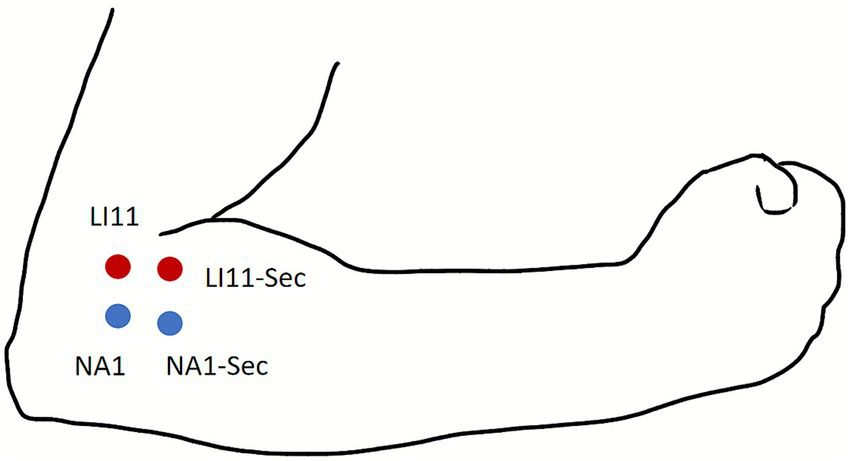 Line drawing of an arm bent at the elbow with markings for acupuncture points. Two red dots labeled LI11 and LI11-Sec are near the elbow crease. Two blue dots labeled NA1 and NA1-Sec are slightly below.