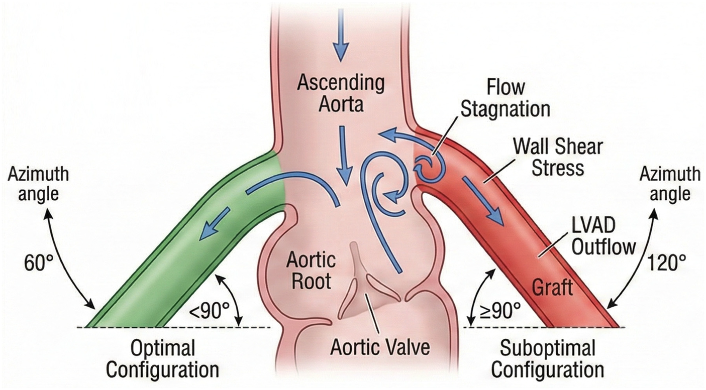 Diagram showing aortic flow dynamics. The left, labeled \"Optimal Configuration,\" has an azimuth angle of sixty degrees with smooth flow through the ascending aorta. The right, labeled \"Suboptimal Configuration,\" shows a one hundred twenty degree azimuth angle, with flow stagnation and wall shear stress near the graft and LVAD outflow.