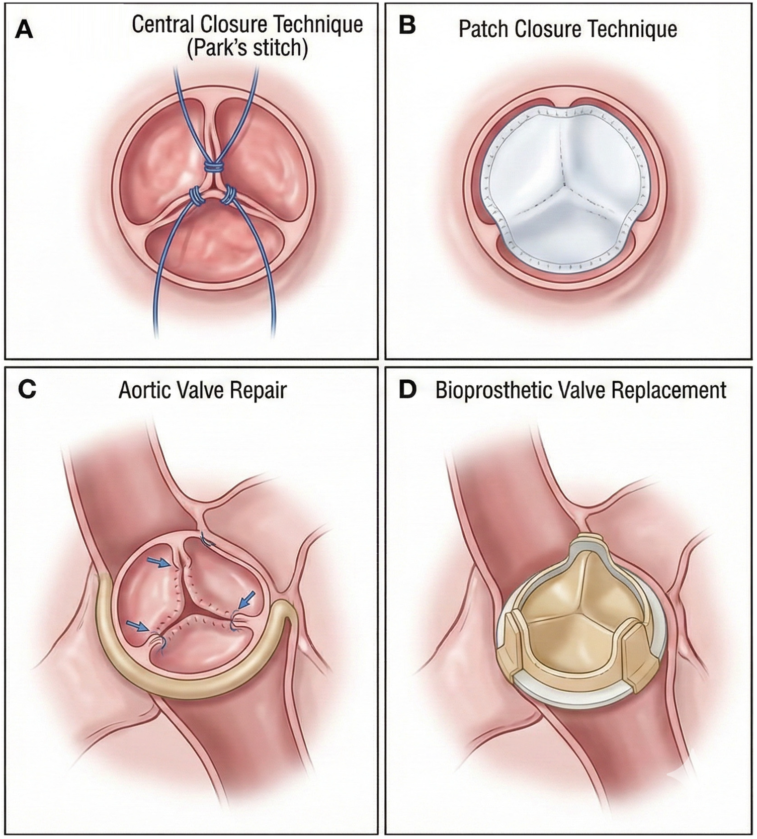 Illustration showing four heart valve repair techniques. Panel A depicts the Central Closure Technique with Park's stitch. Panel B shows the Patch Closure Technique. Panel C illustrates Aortic Valve Repair with directional arrows. Panel D displays Bioprosthetic Valve Replacement.