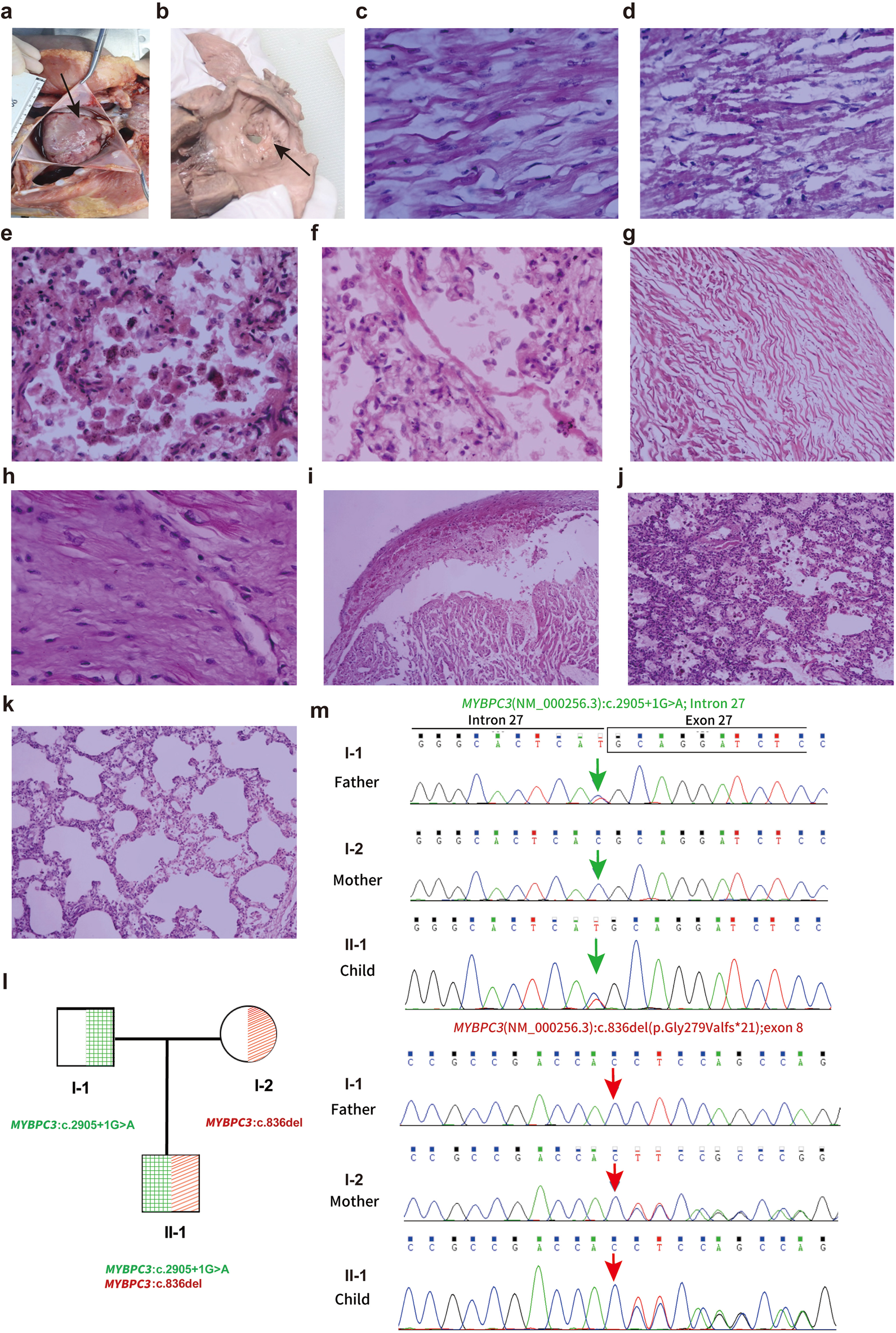 A multi-panel figure includes the following: (a) and (b) show gross anatomical images with arrows pointing to lesions. (c) to (k) display histological images with various tissue patterns under a microscope, stained in pink and purple hues. (l) shows a family pedigree chart indicating genetic mutations, labeled with MYBPC3 gene notations. (m) presents electropherograms demonstrating genetic sequences for different family members, highlighting MYBPC3 mutations.