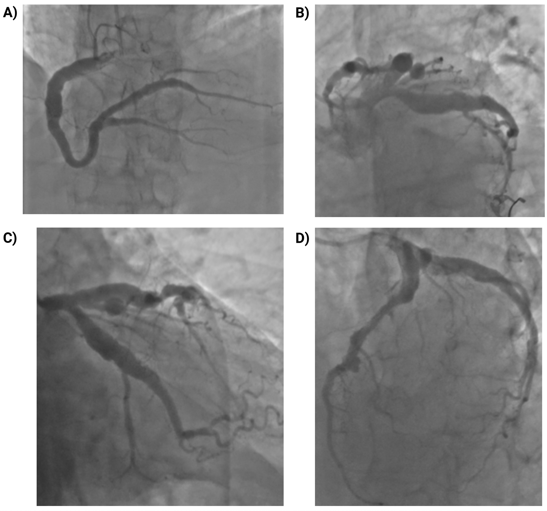 Coronary angiogram images showing different views of arteries. A) Displays a curved artery with branching vessels. B) Shows an artery with multiple rounded structures. C) Features an artery with a coiled appearance. D) Illustrates a looped artery with various small branches.