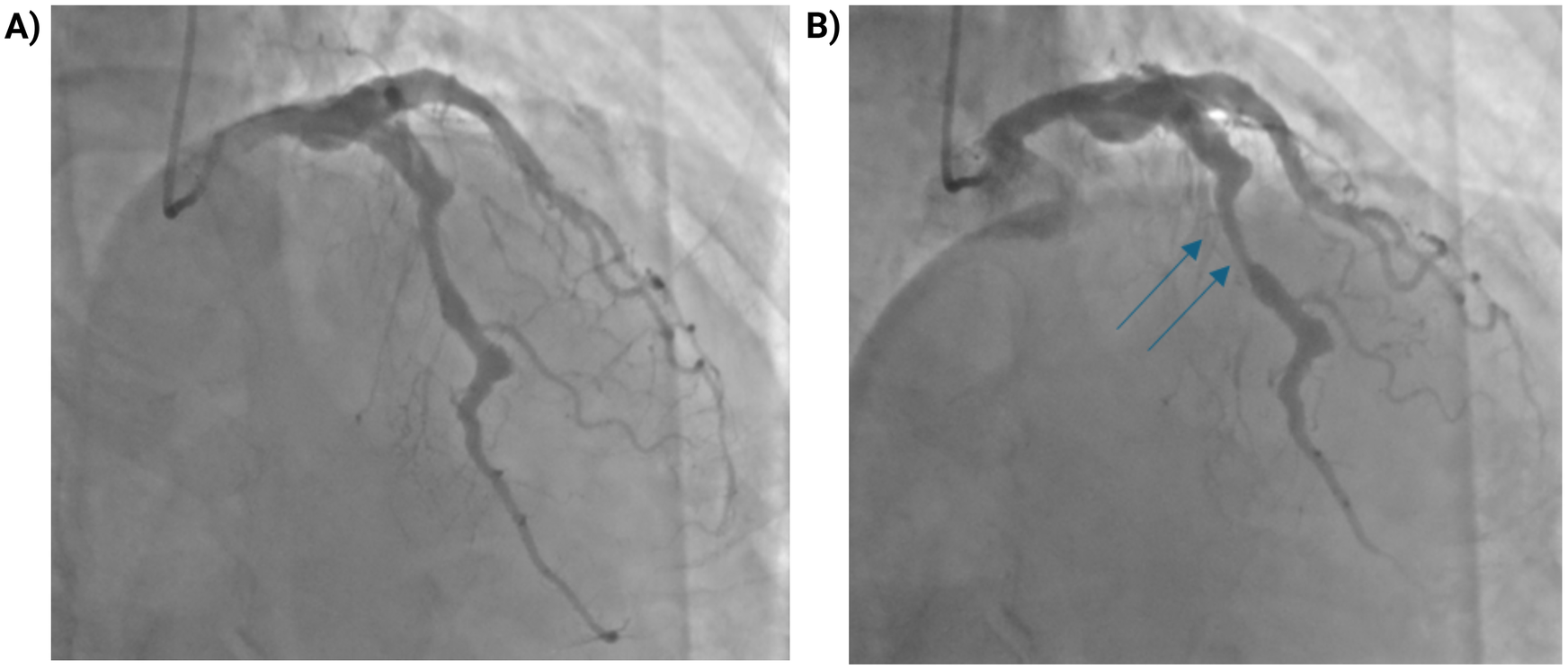 Two angiogram images labeled A and B show coronary arteries. Image A displays clear arterial passages, while image B highlights two narrowing regions with arrows, indicating potential blockages or stenosis in the artery.