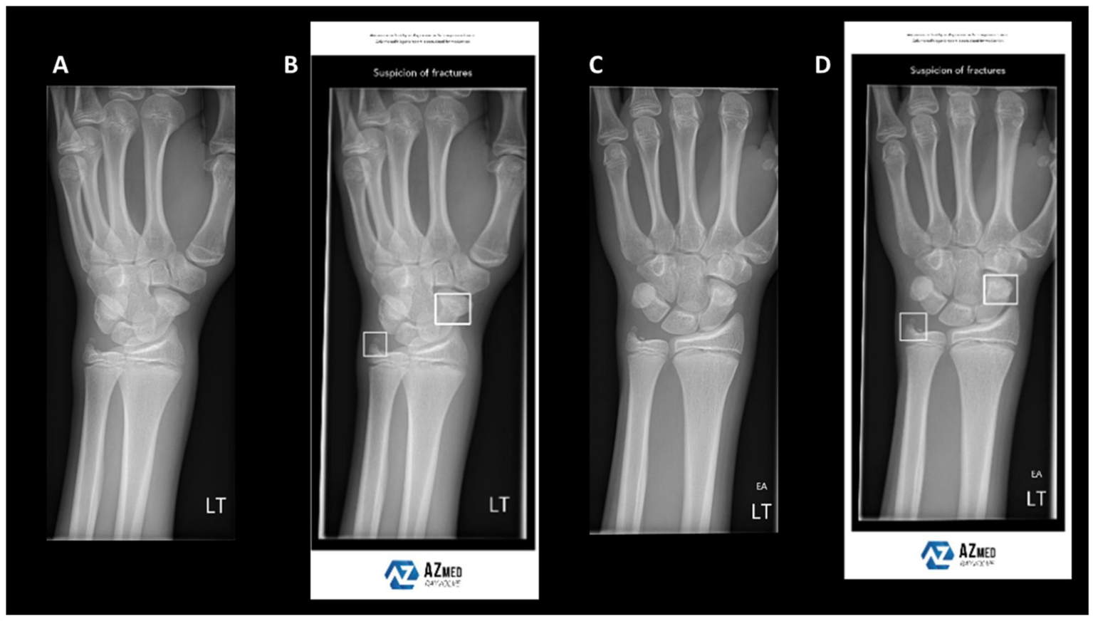 Four X-ray images of a left wrist labeled A to D. Images B and D highlight areas with suspicion of fractures using white squares. Branding for AZMed is visible on images B and D.