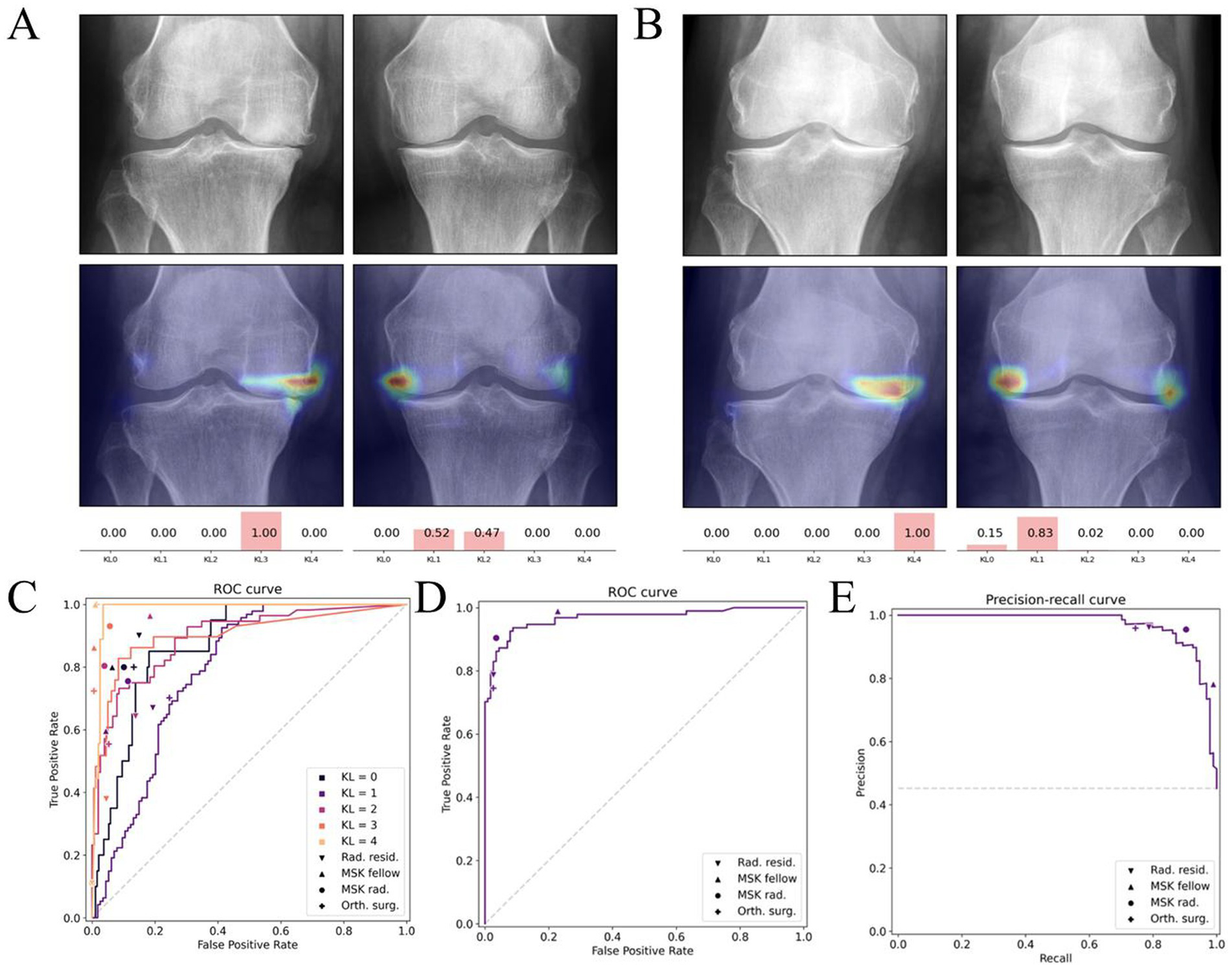 Two panels, A and B, show medical X-rays of knees. Each panel has two rows: the top with X-rays and the bottom with heat maps indicating analysis. Below are ROC (Receiver Operating Characteristic) and Precision-Recall curves in panels C, D, and E. Panel C shows ROC for different KL grades; panel D highlights a single ROC curve; panel E presents a precision-recall curve. Legends identify KL grades and observer roles like radiology residents and musculoskeletal radiologists.