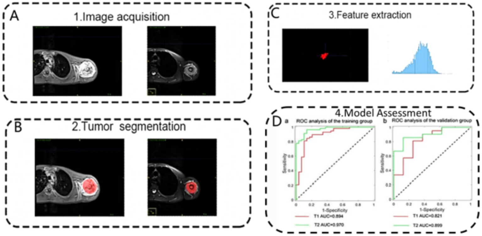 A four-step workflow in medical imaging analysis. A shows image acquisition with two MRI scans. B depicts tumor segmentation with highlighted red areas in two images. C illustrates feature extraction with a 3D scatterplot and a histogram. D shows model assessment using ROC curves, with graphs for training and validation groups, displaying AUC values for T1 and T2 sequences.