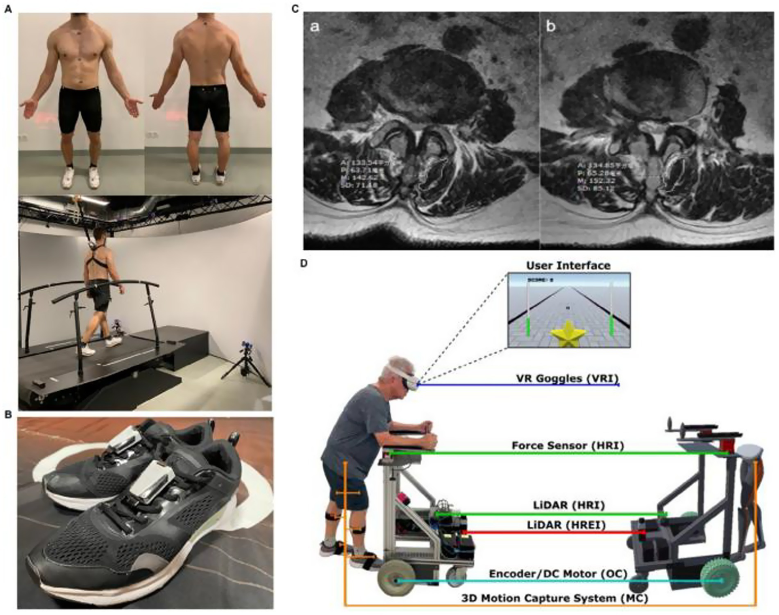 (A) Shows a man in black shorts standing front and back, and walking on a treadmill. (B) Displays black sneakers with electronic sensors. (C) MRI images labeled a and b, showing spinal features with measurements. (D) Depicts a person using VR goggles and interacting with a system involving sensors, LiDAR, and motion capture technology.