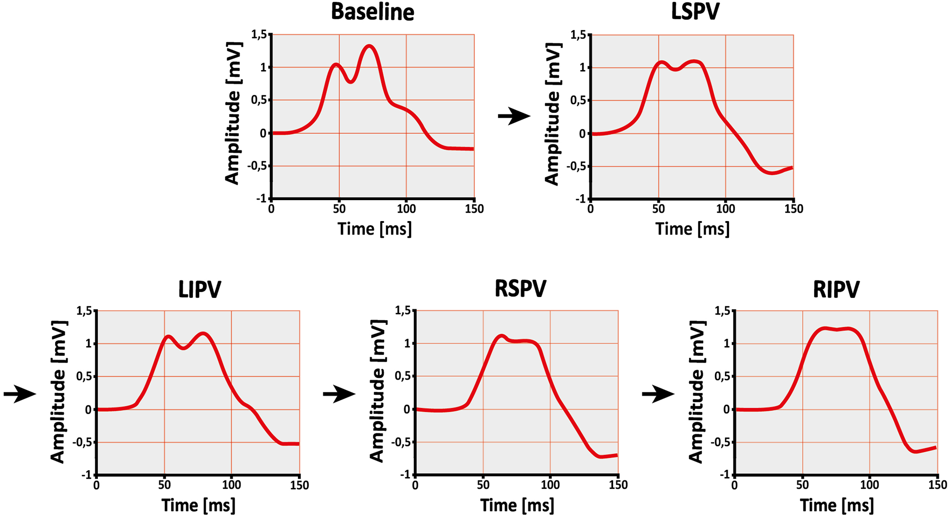 Five graphs display the P-wave as amplitude (mV) over time (ms). Arrows indicate the ablation sequence. Each graph represents a specific time point during the ablation procedure: Baseline, LSPV, LIPV, RSPV, and RIPV. The shape of the P-wave changes progressively across the different ablation stages.