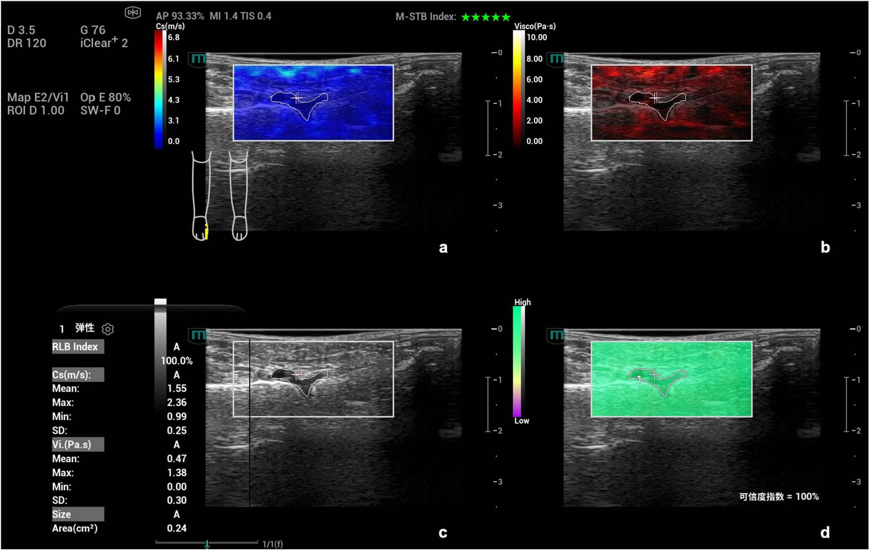 Ultrasound scan with four quadrants displaying elasticity imaging in various color scales: blue, red, grayscale, and green. Each quadrant shows a marked area with measurements. Left side contains numerical data such as mean, max, and min values, indicating tissue characteristics. Color bars represent different scales for intensity.