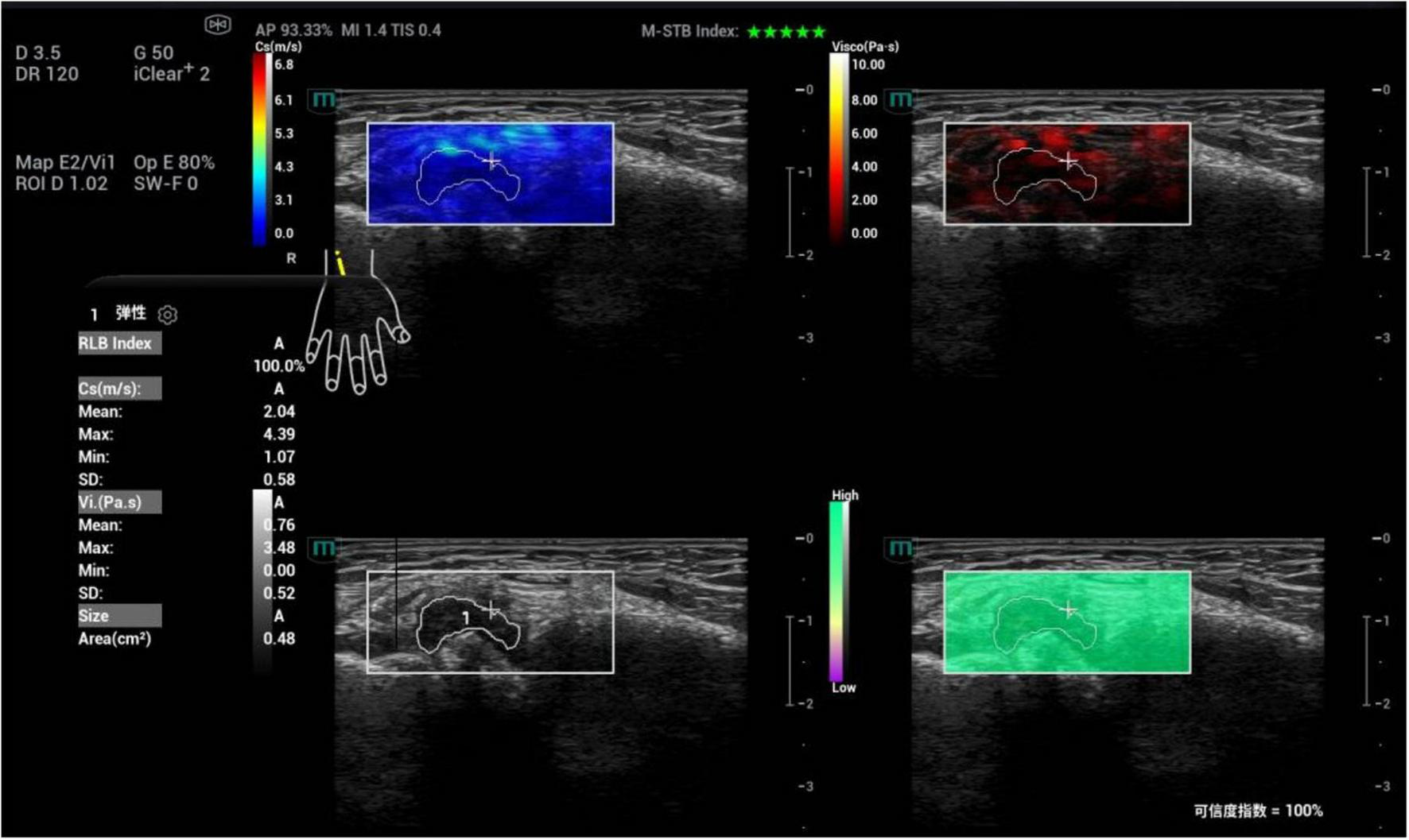 Ultrasound image with four panels showing elastography results of a joint synovium. The panels display different color maps and measurements including Cs(m/s), Vi(Pa.s), and area in square centimeters. Color scales indicate tissue stiffness, with varying hues of blue, red, and green. A foot schematic is shown, highlighting measurement points.