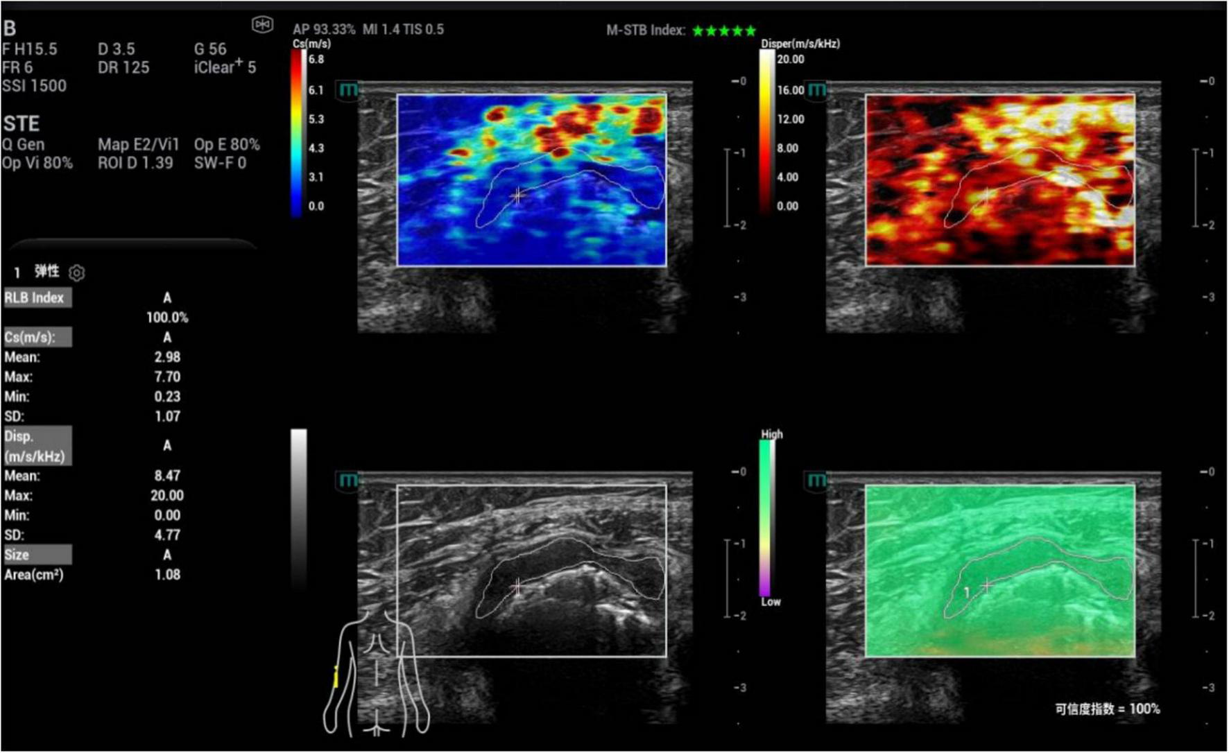 Medical imaging display showing four ultrasound scans with varying color maps. The top left image uses a blue to red spectrum to display data, while the top right image uses shades of red and yellow. The bottom left image is in grayscale. The bottom right image displays data in green shades. Each scan is bordered with measurements and indices on the left, including RLB Index, mean velocity, and size. A diagram of a human torso indicates scan location.