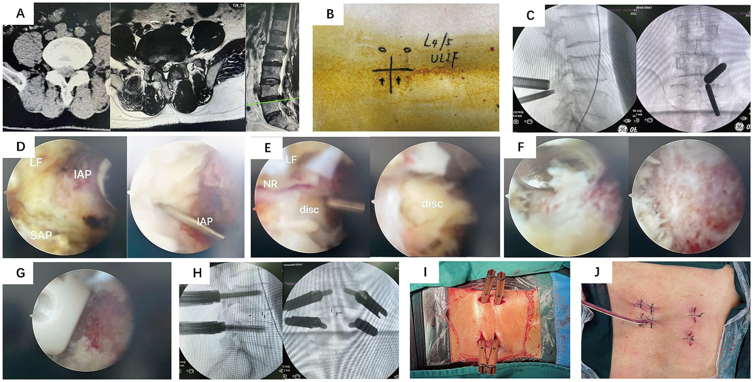 A montage of ten images depicting various stages of a medical procedure, labeled A to J. Panel A shows diagnostic imaging of the spine. Panel B features pre-surgical skin markings labeled "L4/5 ULIF." Panel C displays X-ray images during surgery. Panels D, E, and F contain endoscopic views highlighting anatomical structures such as the inferior articular process (IAP), ligamentum flavum (LF), and spinal disc. Panel G captures a surgical tool in contact with bone. Panel H presents X-ray images with surgical instruments in place. Panel I shows an open surgical site. Panel J depicts the post-operative sutured incisions on a patient's back.