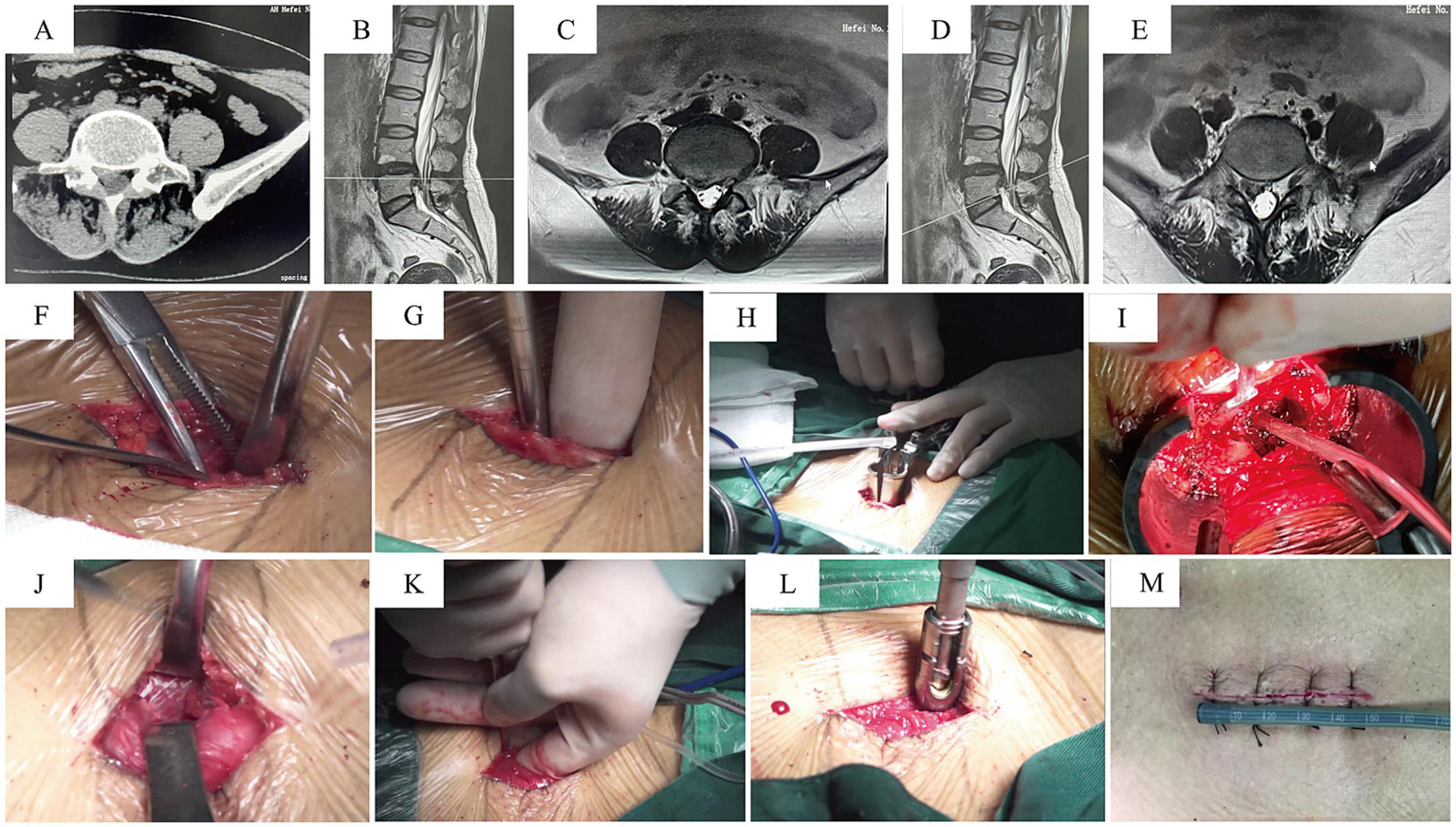 Medical series showing preoperative imaging and surgical procedure. Panels A-E include CT and MRI scans of lumbar spine, highlighting spinal structures. Panels F-M depict surgical steps: incision, retraction, instrument placement, tissue manipulation, and wound closure with sutures. Surgical tools and techniques are visible, illustrating the progression from initial incision to final suturing.