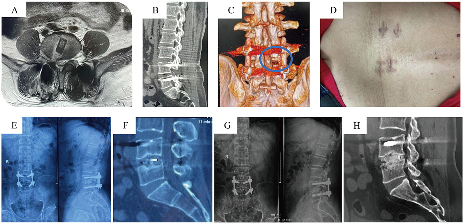 MRI and X-ray images display the lumbar spine from various angles. Panel A shows a transverse MRI scan. Panel B is a sagittal CT scan. Panel C features a 3D reconstruction highlighting a specific area in blue. Panel D depicts a back with healed surgical scars. Panels E and G contain X-rays illustrating spinal hardware. Panel F shows a close-up X-ray of the vertebrae. Panel H presents a lateral CT image of the lumbar spine.