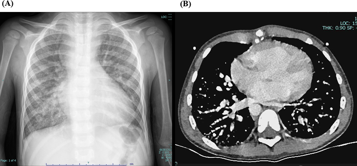 (A) Frontal chest X-ray showing ribs, spine, and lungs, with an enlarged cardiothoracic ratio (0.6) and prominent pulmonary markings. (B) CT scan of the chest showing a cross-sectional view with visible heart and lung structures. extensive bilateral pulmonary arteriovenous malformations (PAVMs), more pronounced in the lower lobes.