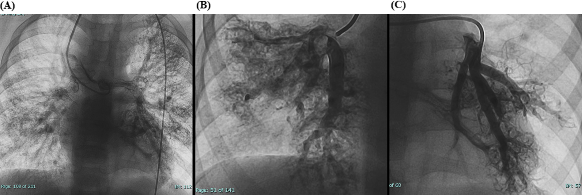 Three-panel medical imaging display. (A) Preoperative cardiac catheterization showing diffuse bilateral pulmonary arteriovenous malformations (PAVMs). (B) Local angiographic view of the right lower lobe showing PAVMs more pronounced in this region. (C) Local angiographic view of the left lower lobe showing PAVMs more pronounced in this region.