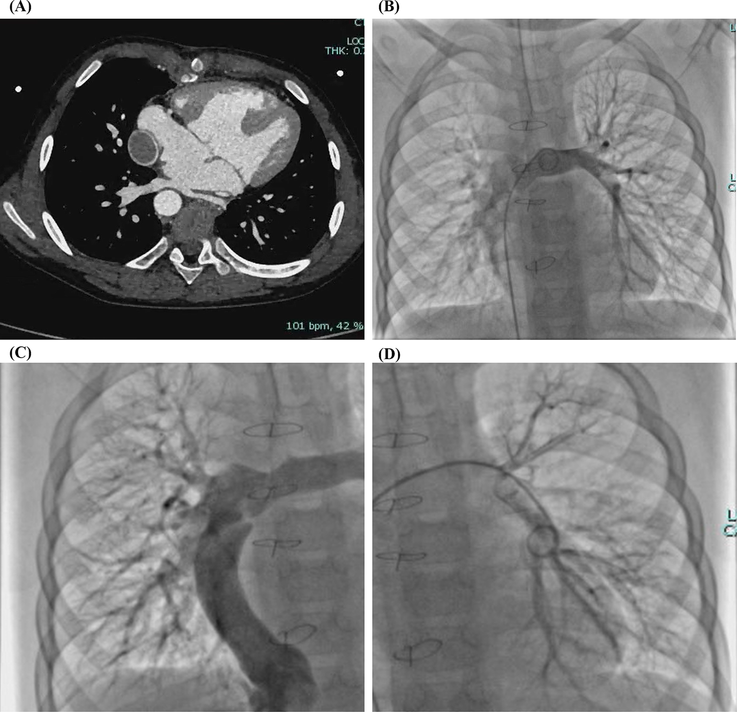 Four-panel cardiac imaging display after total cavopulmonary connection (TCPC). (A) Contrast-enhanced cardiac CT showing a cross-section of the thorax, confirming complete disappearance of bilateral diffuse pulmonary arteriovenous malformations (PAVMs) and highlighting the heart and major blood vessels. (B) Cardiac catheterization showing complete resolution of PAVMs in the frontal view. (C) Cardiac catheterization showing complete resolution of PAVMs in the right lower lung angiographic view. (D) Cardiac catheterization showing complete resolution of PAVMs in the left lower lung angiographic view.