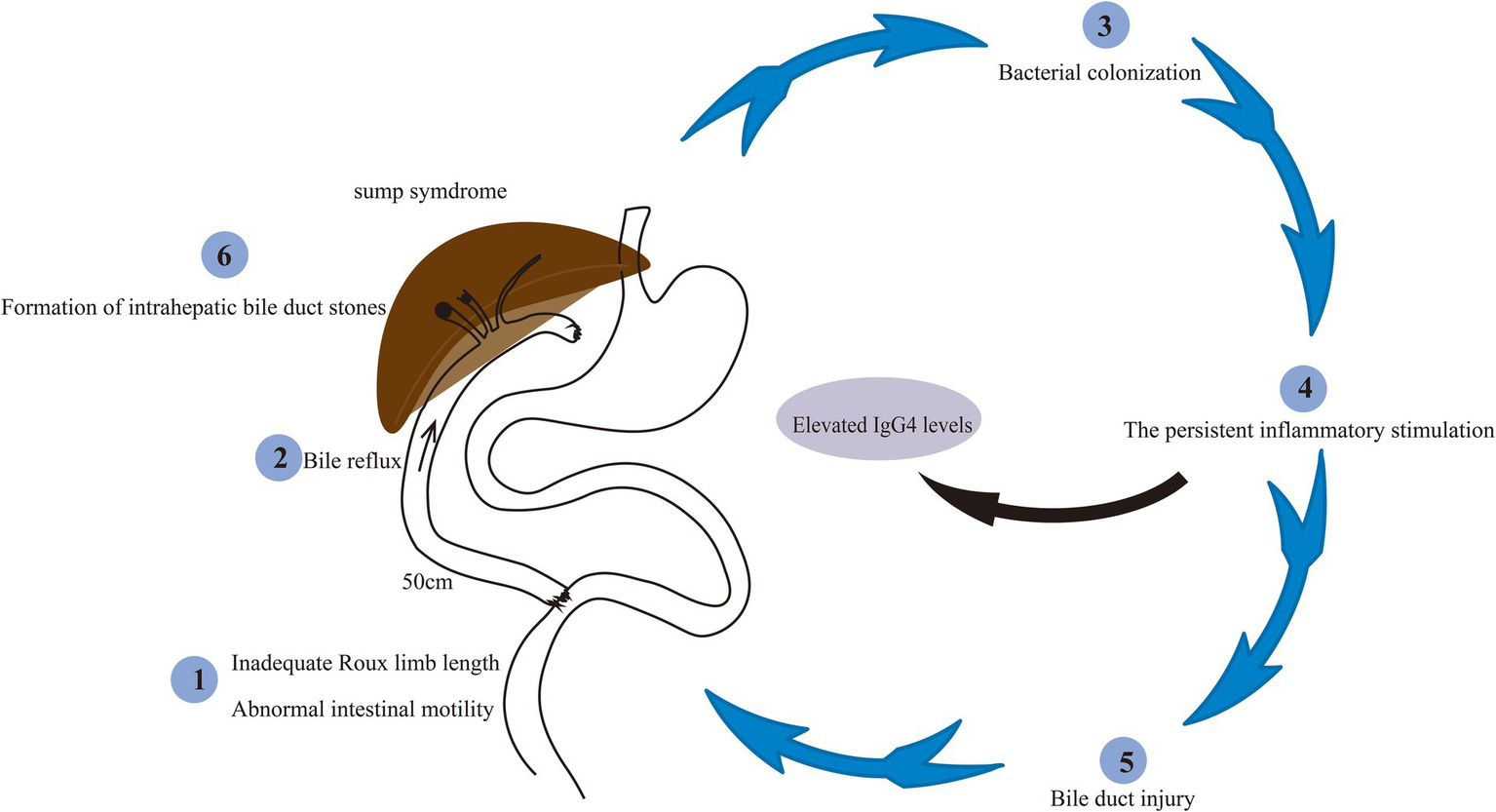 Diagram illustrating a cyclical process related to bile duct issues. Steps include inadequate Roux limb length and abnormal intestinal motility, leading to bile reflux, bacterial colonization, persistent inflammatory stimulation, bile duct injury, and formation of intrahepatic bile duct stones. Elevated IgG4 levels and sump syndrome are noted. Arrows depict the cycle's progression.