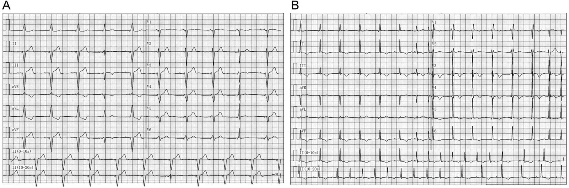 Two panels labeled A and B, each showing an electrocardiogram (ECG) with multiple leads including I, II, III, aVR, aVL, aVF, and V1 to V6. Both panels display heart rhythms with variations in waveforms, grid background.