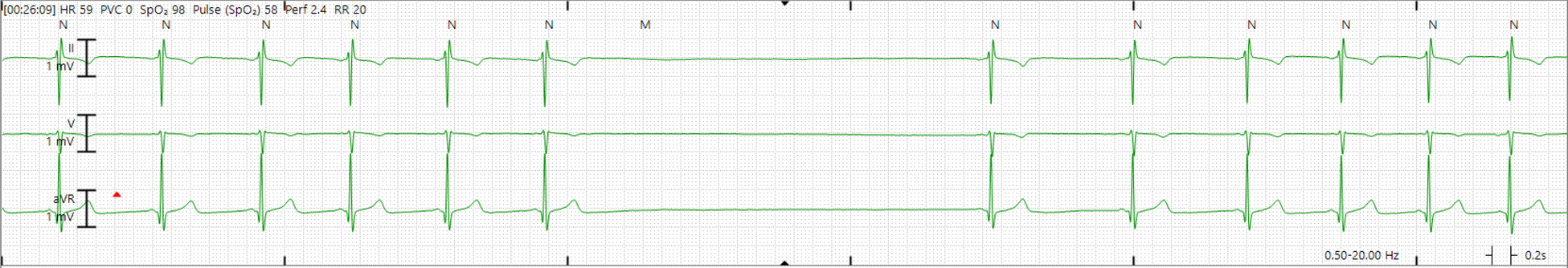 Three telemetry leads from patient A showing normal sinus rhythm at a heart rate of 59 beats per minute with no premature ventricular contractions (PVC). There is a 4.2 second pause between two beats.