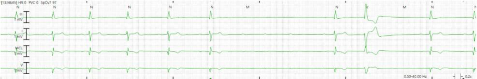 Four telemetry leads from patient A showing normal sinus rhythm and one premature ventricular contraction (PVC). There is a 4.25 second pause between two beats containing p-waves but no QRS complexes.
