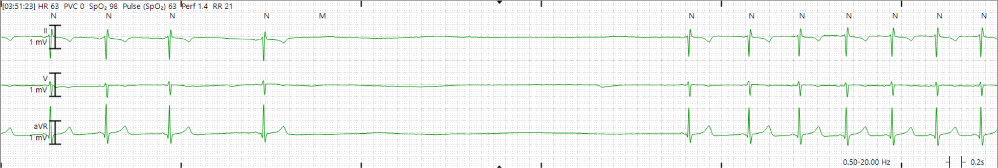 Three telemetry leads from patient B showing normal sinus rhythm at a heart rate of 63 beats per minute with no premature ventricular contractions (PVC). There is a 6.6 second pause between two beats.