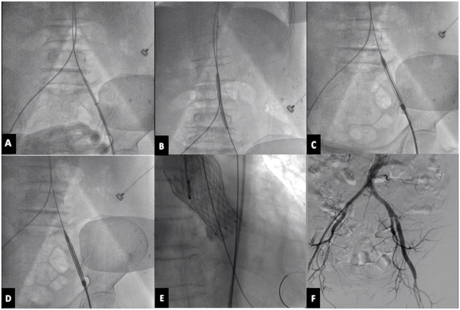 A six-panel figure displaying angiographic images of a TAVR procedure. Panel A shows the insertion of a 16F sheath into the femoral artery. Panel B depicts a balloon catheter dilating the arterial stenosis. Panel C illustrates the passage of the delivery system through the vessel. Panel D shows the positioning of the VENUS-A valve. Panel E displays the fully released prosthetic aortic valve. Panel F presents an angiogram of the iliofemoral artery to assess vessel integrity.