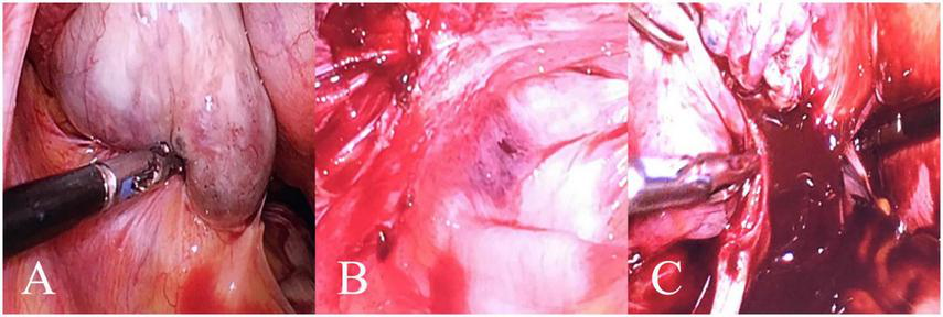 Three-panel image showing surgical procedures. Panel A shows a tool interacting with tissue. Panel B focuses on internal tissue with visible textures. Panel C displays another angle of tissue with surgical instrument contact.